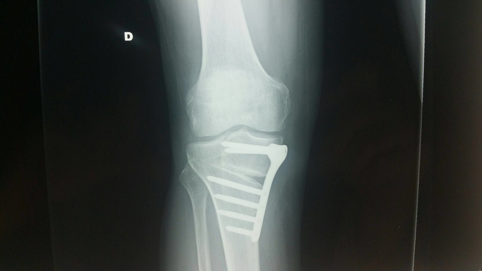 Flexit xray 1