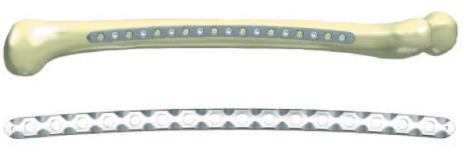 PediLoc® Bowed Femur Plate PediLoc® Bowed Femoral Plate