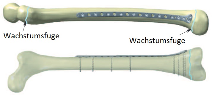 PediLoc® Contoured Femur Plate PediLoc® Contoured Femoral Plate